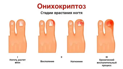 Onychokryptose - Stadien des Einwachsens der Nägel