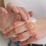ein-einfaches-mittel-zur-linderung-von-psoriasis-symptomen-wurde-genannt.jpg